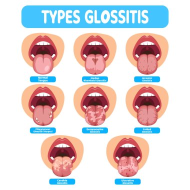 illustration of the oral infection disease glossitis, great for media infographics, banners and flyers clipart