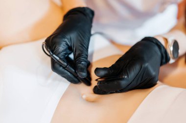 Doktorun yakın görüntüsü, elektro iğne ve cımbız kullanarak hastaya elektroepilasyon yapmaktır. Saç çıkarma prosedürü, profesyonel güzellik hizmetleri. Güzellik uzmanları eldiven giyer. Yüksek kalite fotoğraf