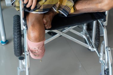 Pinrang Endonezya, 10 Ocak 2024: Diz ampütasyonunun altında, orta yaşlı bir adamın portresi diz altından kesilmiş, tekerlekli sandalyede oturuyor, Pare-pare Endonezya