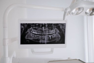 Modern bir klinikteki bir monitörde diş röntgeni görüntüsü gösteriliyor, oral sağlık teşhislerini vurguluyor. Yüksek kalite fotoğraf