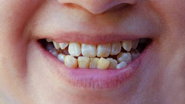 Ağzında sarı hasta ve eksik dişleri olan bir kadın sigara içen bir ağız, dişçi randevusu ve protezden önceki dişlerini gösteriyor, konsept ortodonti ve stomatoloji, kötü dişler.