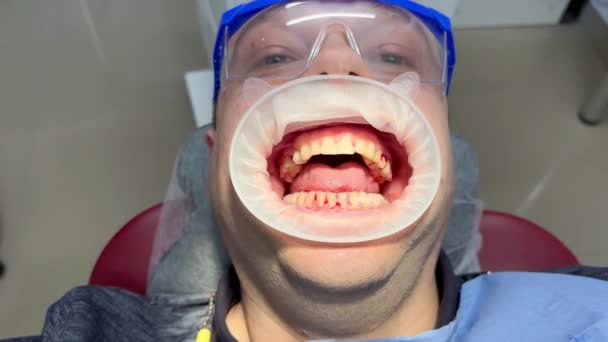 口腔の専門的な洗浄後 歯科クリニックで若い男の広い開いた口を持つ保護メガネの患者の顔 超音波デンタルスケーラーの後に歯茎を出血させます タールと色素性プラークの除去 歯科用車 — ストック動画