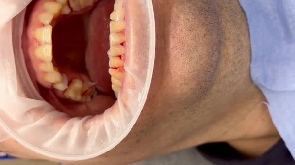 Κοντινό Πλάνο Της Στοματικής Κοιλότητας Ενός Ανδρικού Ασθενούς Οδοντιατρική Κλινική — Αρχείο Βίντεο
