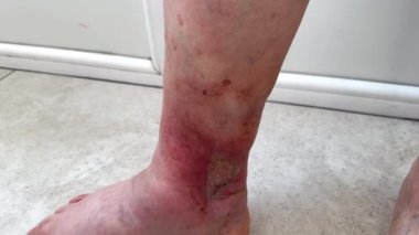 Bir adamın şişmiş kırmızı bacağında çürümeye başlayan büyük açık bir yara var. Bacağında trofik ülser, iltihaplanma süreci, mikroflora tedavileri. Tıbbi bakım konsepti, insan dokularının yenilenmesi. Egzama. Varisli damarlar.
