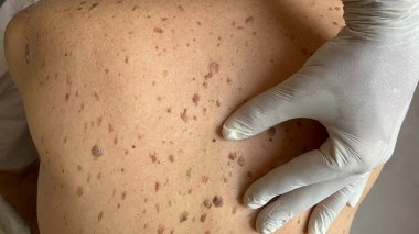 Eldiven giyen bir sağlık uzmanı hastaların sırtlarındaki çeşitli boyutlarda ve şekillerde benleri inceler..