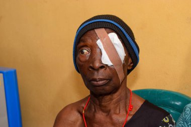 Abuja, Nijerya - 25 Aralık 2021: Orta yaşlı Afrikalılar Katarakt teşhisi kondu ve ameliyata hazırlandılar
