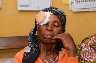Abuja, Nijerya - 25 Aralık 2021: Orta yaşlı Afrikalılar Katarakt teşhisi kondu ve ameliyata hazırlandılar