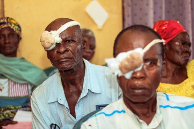 Abuja, Nijerya - 25 Aralık 2021: Orta yaşlı Afrikalılar Katarakt teşhisi kondu ve ameliyata hazırlandılar