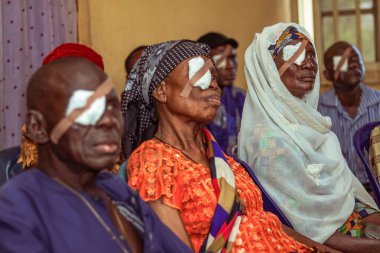 Abuja, Nijerya - 25 Aralık 2021: Orta yaşlı Afrikalılar Katarakt teşhisi kondu ve ameliyata hazırlandılar