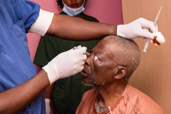 Abuja Nigeria Agosto 2021 Agli Africani Diagnosticata Cataratta Negli Occhi — Foto Stock