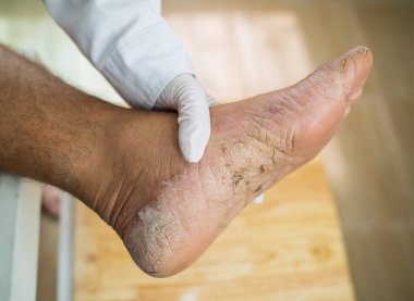 Çok ağır bir insanın kırık topuğunun yakın plan çekimi. Bir çatlak açılışı var.