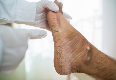 Çok ağır bir insanın kırık topuğunun yakın plan çekimi. Bir çatlak açılışı var.