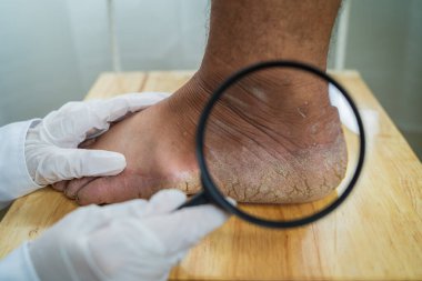 Çok ağır bir insanın kırık topuğunun yakın plan çekimi. Bir çatlak açılışı var.