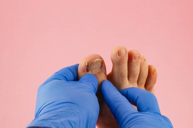 Bir tıp uzmanı mavi eldiven giyerken hastanın ayak parmaklarını muayene eder ve tedavi eder. Arka plan yumuşak bir pembe, ayak bakımına odaklanmayı vurguluyor..