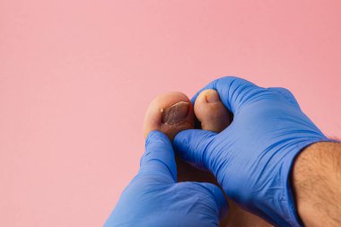 Mavi eldivenli bir tıp uzmanı, tedavi sırasında rahatlık ve bakım sağlarken, bir hastanın ayak parmağını nazikçe muayene eder..