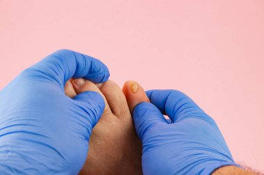 Mavi eldiven giyen bir kişi yaralı bir ayak parmağını pembe arka planda nazikçe inceler. Odak noktası ayak parmağının durumu ve dikkatli yaklaşım..