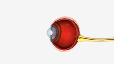 Keratoconus, normalde yuvarlak kornea (gözün ön kısmı) ince ve düzensiz (koni) şeklindeki bir görme bozukluğudur..