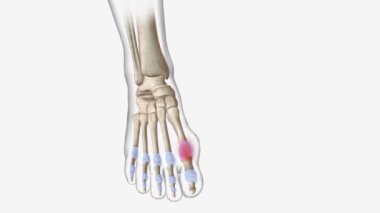 Gut patlamaları genellikle tek bir eklem içinde meydana gelir ve belli gıdalar, alkol, bazı ilaçlar, fiziksel travma veya belirli bir travma tarafından tetiklenebilir. .