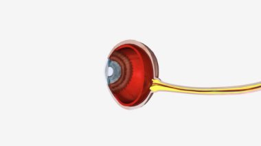 Bazı durumlarda uveitis ile ilişkilendirilen orta stroma (korneanın orta katmanları) kronik ve ülsersiz iltihaplanmadır. .