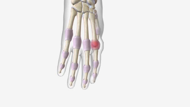 Artritis Temprana Articulación Metacarpofalángica — Vídeos de Stock