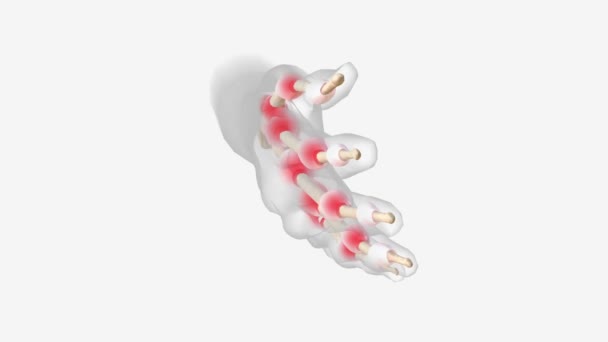 Artritis Reumatoide Avanzada Médico — Vídeo de stock