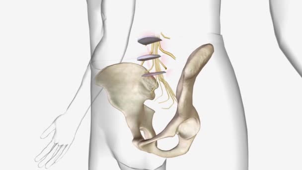 変性脊椎動脈瘤 脊椎の変性変化により 下記のいずれかの椎骨体の滑りを引き起こす疾患です — ストック動画
