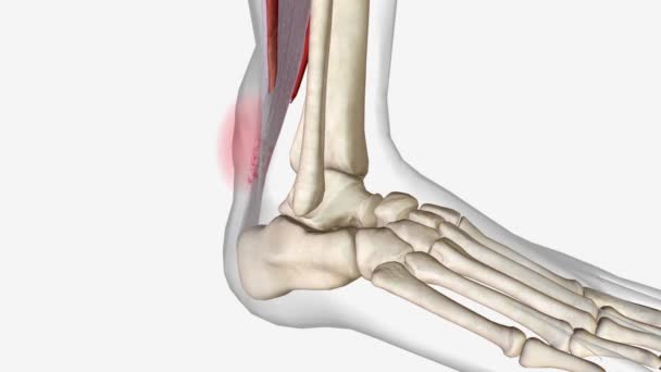 Ankle Strain Thickened Damaged Tendon — Stock Video