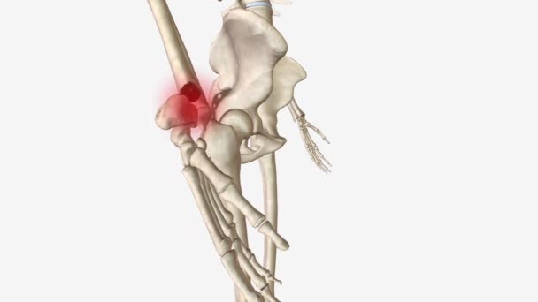 Złamania Kości Promieniowej Najczęstszym Urazem Ortopedycznym Zazwyczaj Wynikiem Upadku Wyciągniętą — Wideo stockowe
