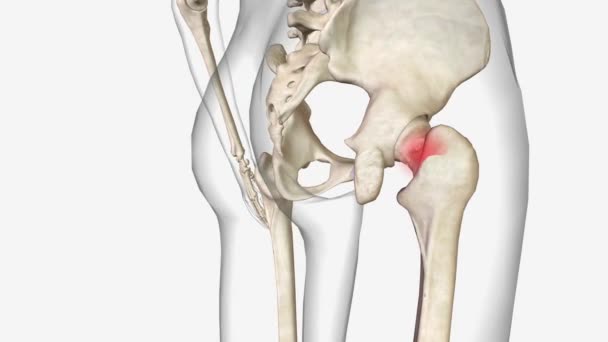 大腿骨首骨折は特定のタイプのカプセル状の股関節骨折です — ストック動画