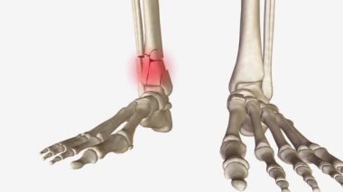 Uzun Kemikler 'in 3 boyutlu tıbbi bileşimi