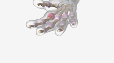 Metacarpophalangeal Ekleminde Erken Artrit .
