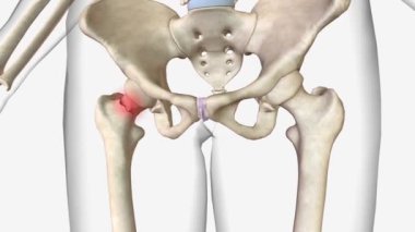 Femoral boyun kırıkları özel bir tür intrakapül kalça kırığı. .