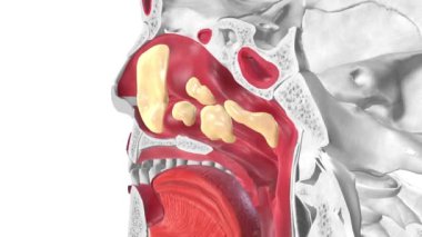 Sinüzit, sinüslerini kaplayan dokunun iltihaplanması ya da şişmesidir..