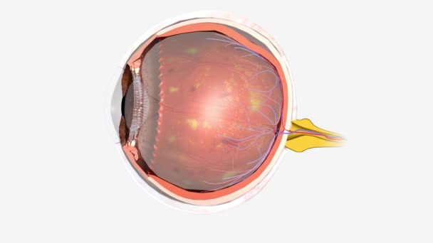 Diabetická Retinopatie Oční Onemocnění Které Může Způsobit Ztrátu Zraku Slepotu — Stock video