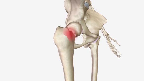 大腿骨首骨折は特定のタイプのカプセル状の股関節骨折です — ストック動画