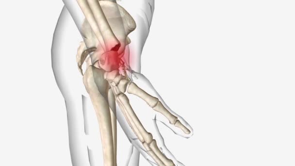 Uzak Yarıçap Kırıkları Yaygın Ortopedik Yaralanmalardır Genellikle Uzayan Bir Elin — Stok video