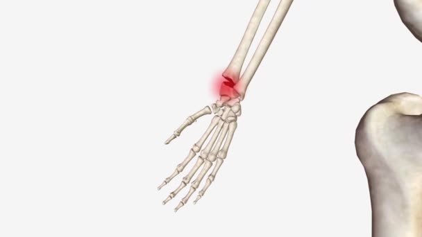 遠位半径骨折は最も一般的な整形外科的損傷であり 一般的に伸展した手の落下によるものです — ストック動画