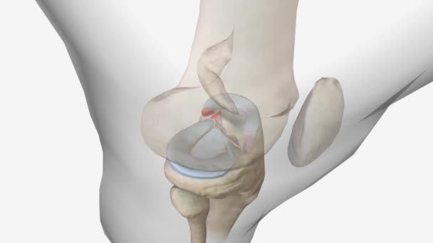 Meniscal Root Tears Less Common Meniscal Body Tears Frequently Undetected — Stock Video
