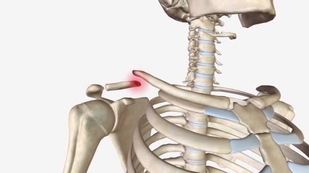 골절은 어깨의 하나인 쇄골의 골절입니다 — 비디오