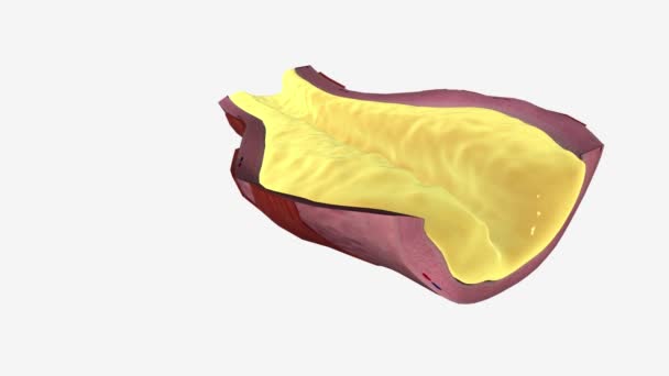 支气管扩张支气管扩张3D医学 — 图库视频影像