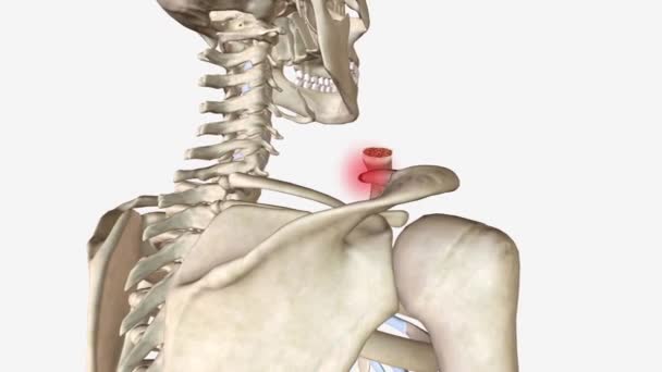 鎖骨骨折は鎖骨の骨折です肩の主な骨の1つです — ストック動画