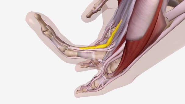 Dupuytren Ist Contracture Central Cord — Stockvideo