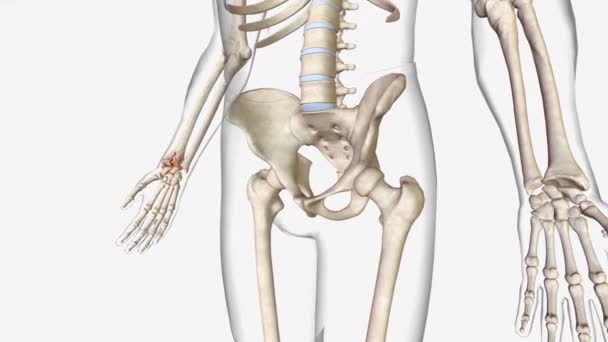 常见骨折是一种骨折类型 — 图库视频影像