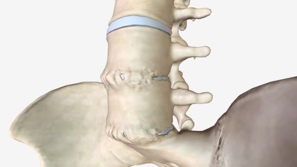 Espondilitis Anquilosante Fusión Ósea Entre Vértebras Lumbares — Vídeo de stock