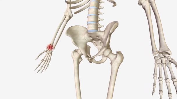 Осколочные Переломы Тип Сломанной Кости — стоковое видео