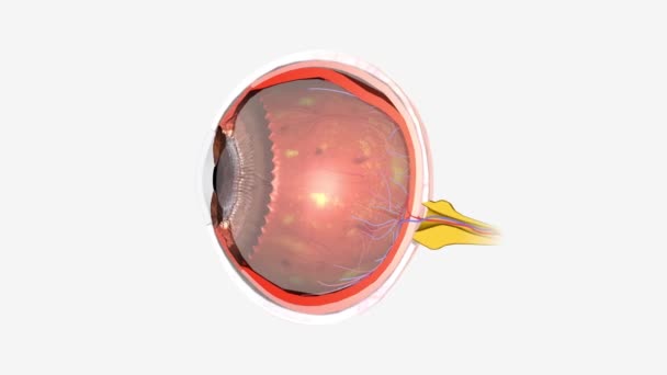 Retinopatía Diabética Una Afección Ocular Que Puede Causar Pérdida Visión — Vídeo de stock