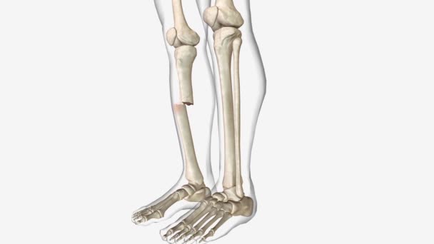 骨折とも呼ばれる骨折は骨折した骨の近くの皮膚に開いた傷や骨折がある骨折です — ストック動画