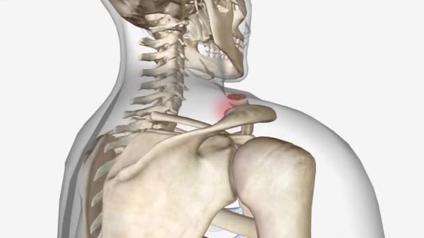 鎖骨骨折は鎖骨の骨折です肩の主な骨の1つです — ストック動画