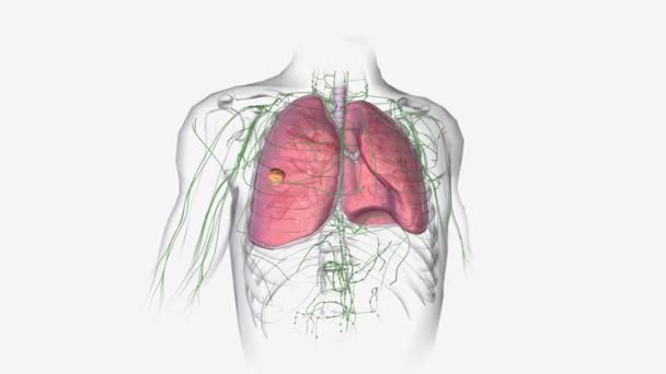在2A期肺癌中 肿瘤在4厘米至5厘米之间 淋巴结清晰 — 图库视频影像