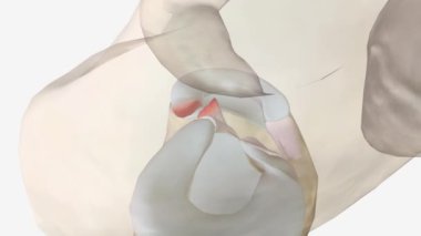 Meniskal kök gözyaşları meniskal vücut yırtıklarından daha az yaygındır ve sık sık fark edilmezler..